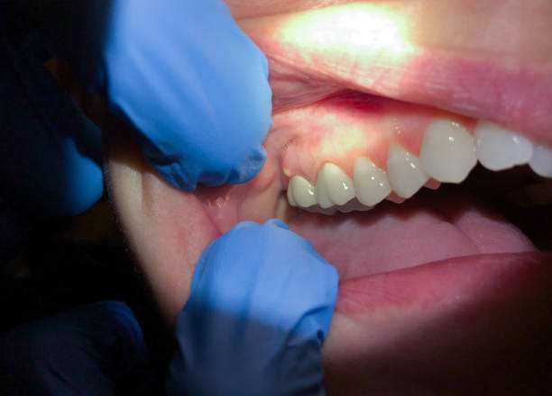 Best Emergency Dental Care for Broken or Chipped Teeth in Shelby, NC